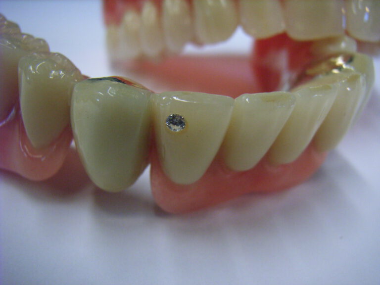 Bearbeitete Zähne | Singener Dental-Labor Crass GmbH